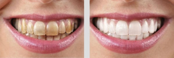 Teeth Whitening PPC